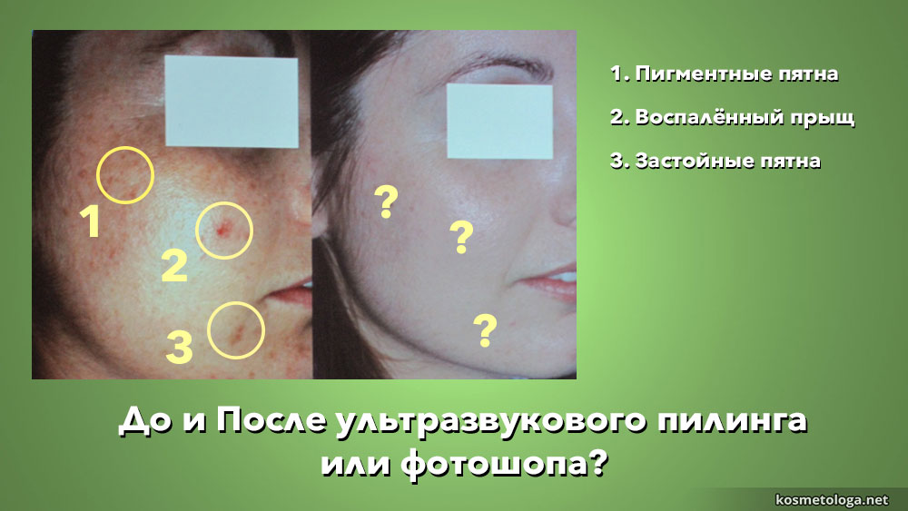 Сравнение двух лиц до ультразвукового пилинга и после. Картинка справа не является результатом пилинга, а является результатом фотошопа.