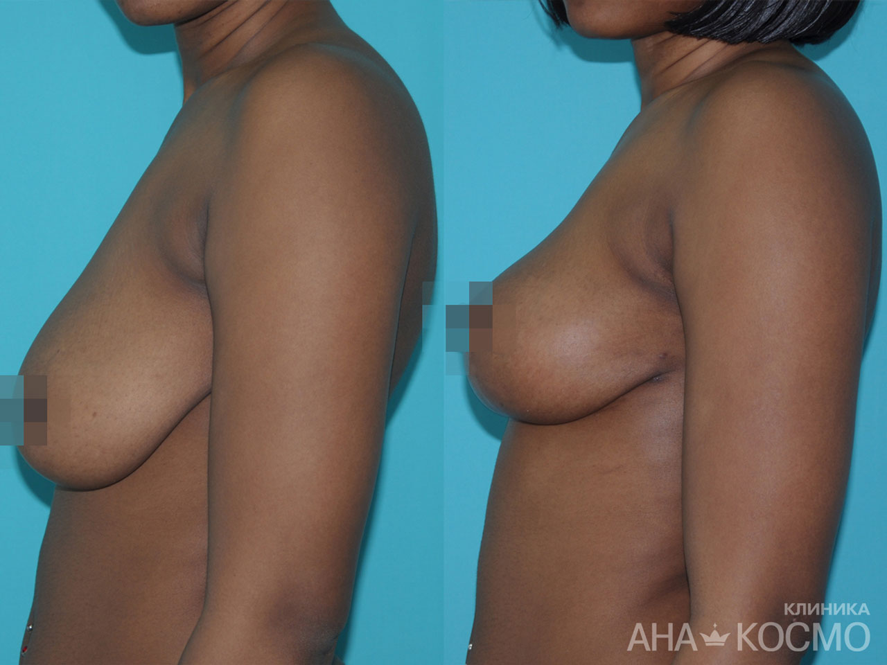 Пластическая операция - коррекция обвисшей груди - Фото До и После
