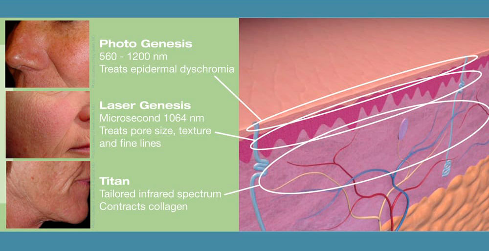  Лазер воздействует на кожу не повреждая верхний слой